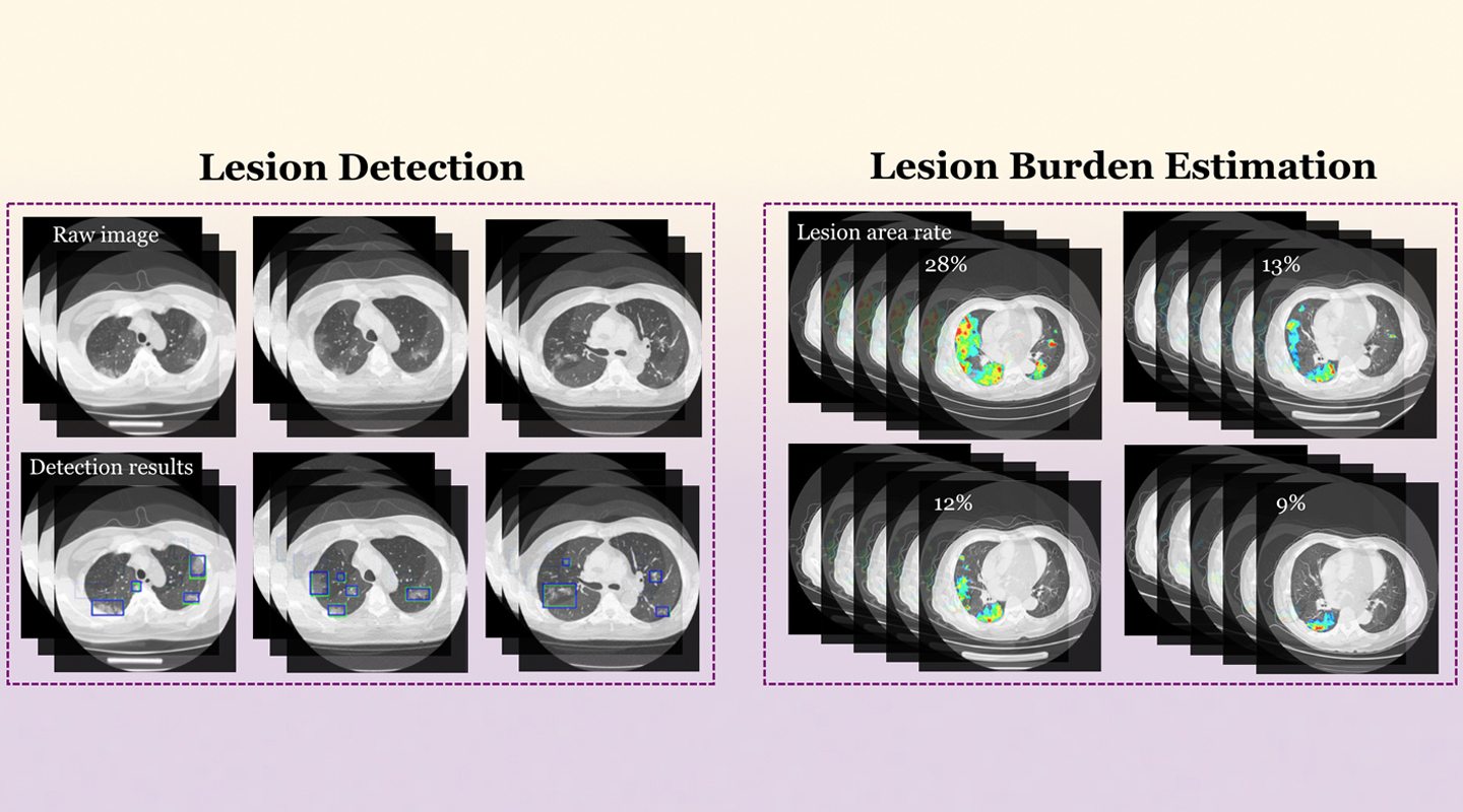 An AI system developed by CUHK can now rapidly and accurately detect COVID-19 infections in chest CT images using the federated learning technique. The model is trained to recognize COVID-19 lesions independently at multiple hospitals with their own stock of CT scans. Their insights are then gathered and contribute to a central model, which returns correct diagnosis 95% of the time. Throughout the process, the training images remain with individual hospitals without having to go into the same pool and potentially leading to privacy breaches