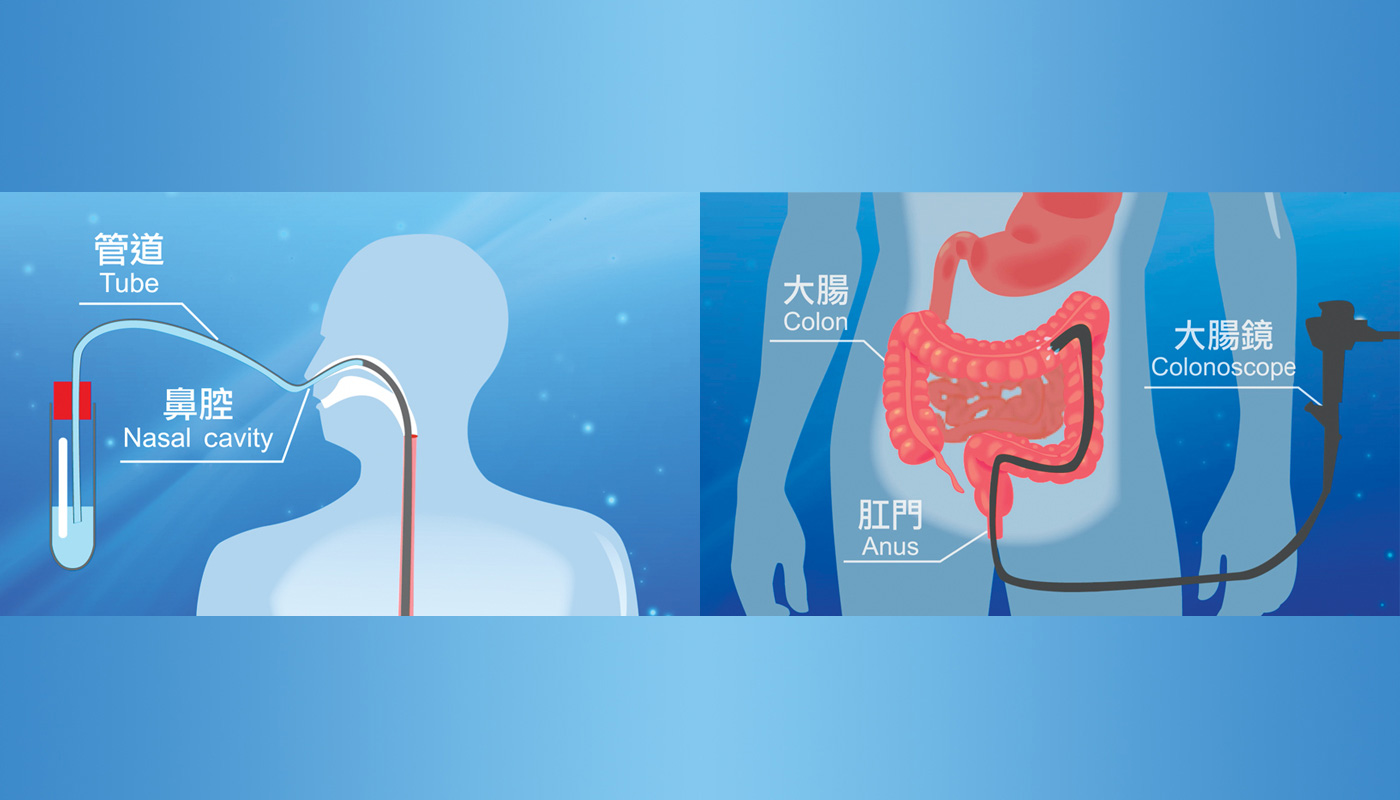 液體以内窺鏡送到病人的小腸或結腸