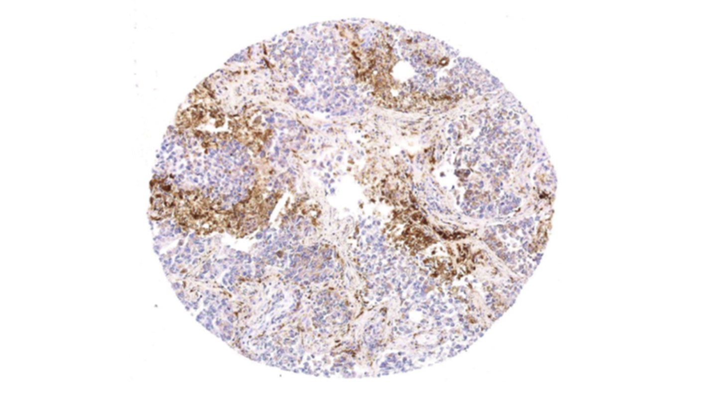 肺癌活檢中的細胞核（染為紫色）及與腫瘤相關的巨噬細胞（染為棕色）<em>（由受訪者截圖展示）</em>