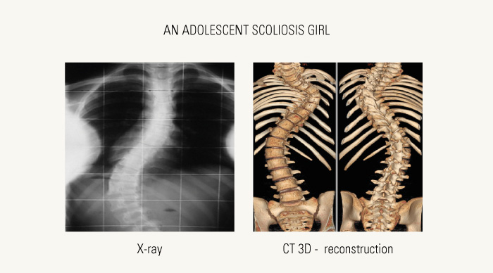 X-ray and CT images of scoliosis