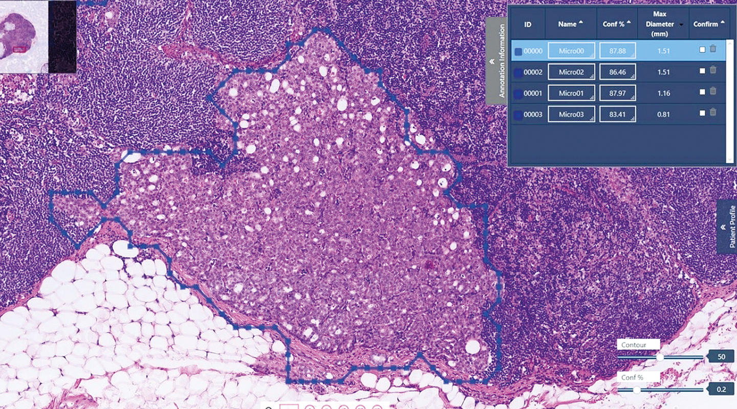 系統自動識別乳癌細胞（藍線圈畫部分）