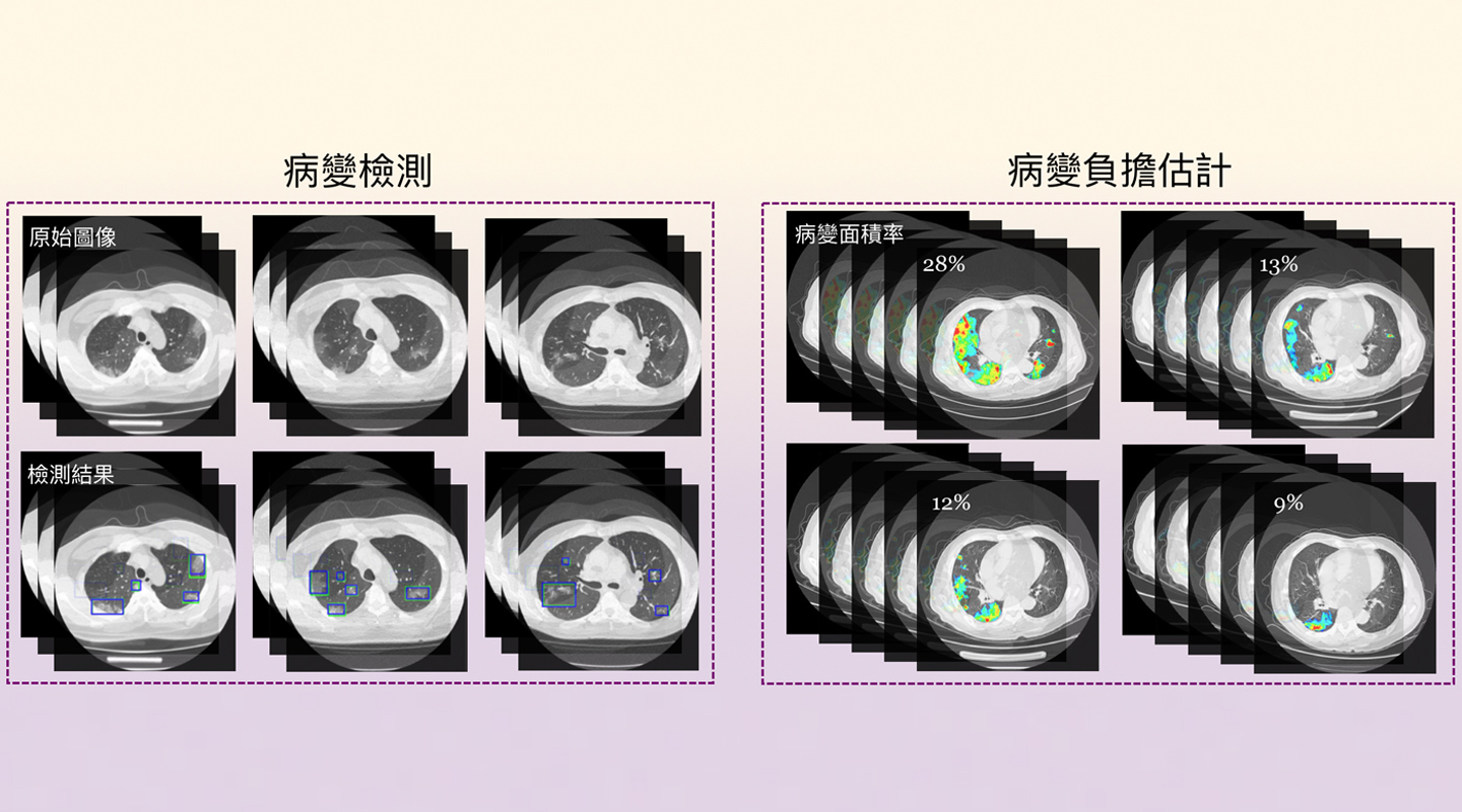 人工智能便利新冠肺炎醫療影像分析